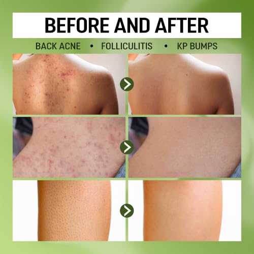 High-Performance Folliculitis Treatment Body Wash