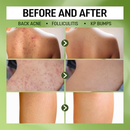 High-Performance Folliculitis Treatment Body Wash