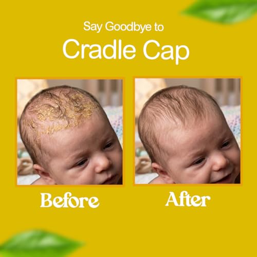 Bee Gone Cradle Cap Shampoo