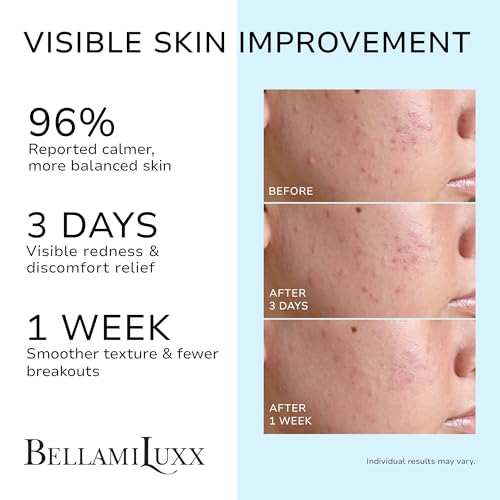 Cystic Acne Treatment for Face: Hormonal Acne Treatment Cream for Teens & Adults - Salicyl