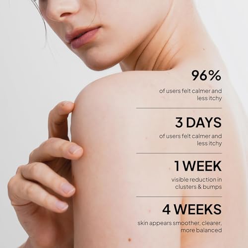 Fungal Acne Treatment Lotion: Effective Face & Body Pimple Cream
