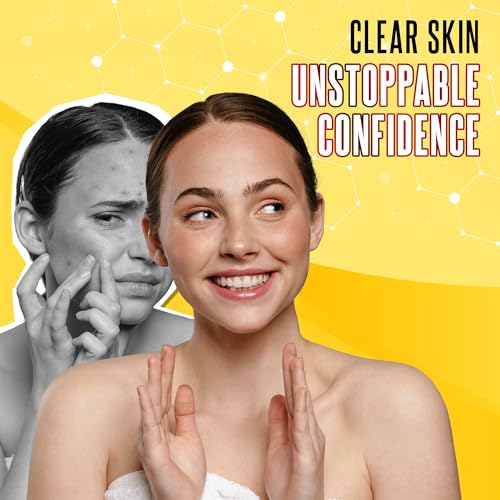 Grisi 10% sulfur acne bar soap 3 pack