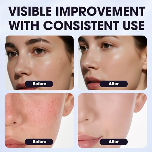 Arbutin 8% + Tranexamic Acid 5% Cream for Dark Spots