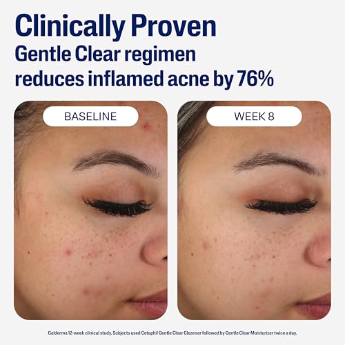Gentle Clear Mattifying Acne Face Moisturizer