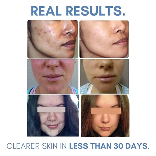 Acne Lotion with Benzoyl Peroxide