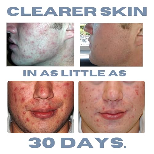 Acne Lotion with Benzoyl Peroxide