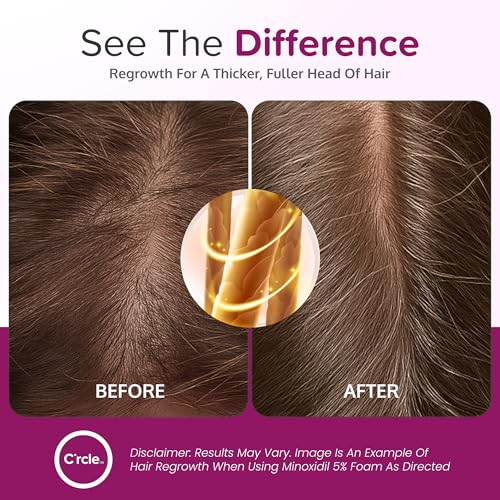 Helps Restore Top of Scalp Hair Loss