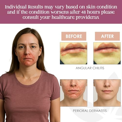 Seborrheic Dermatitis Face Cream
