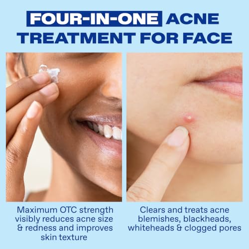 Acne Spot Treatment 10% Benzoyl Peroxide