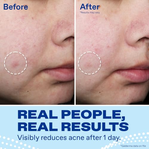 Acne Spot Treatment 10% Benzoyl Peroxide