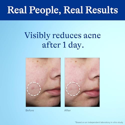 Acne Spot Treatment 10% Benzoyl Peroxide