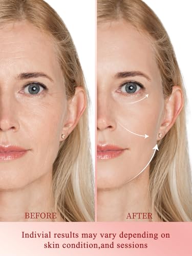 Radio Frequency Skin Tightening Device Anti-Aging Face Machine