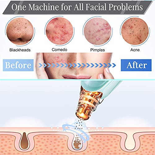 Blackhead Remover Pore Vacuum Cleaner USB 5 Probes