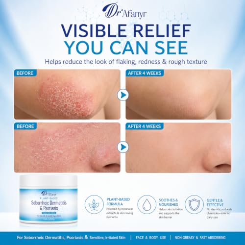 Seborrheic Dermatitis Care Cream - Dry Scalp Face & Body Moisturizer with Anti Itch & Dand