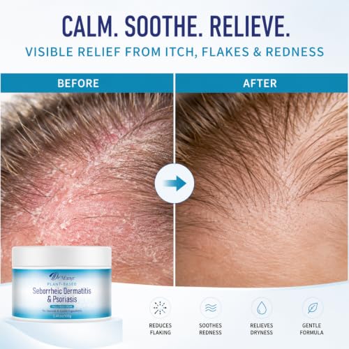 Seborrheic Dermatitis Care Cream - Dry Scalp Face & Body Moisturizer with Anti Itch & Dand