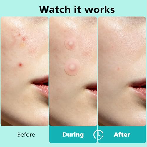 563 Count Hydrocolloid Acne Patches Face Body