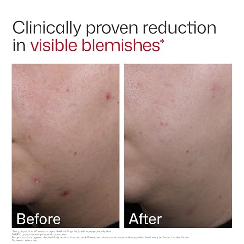 UV Clear Blemish-Prone SPF 50