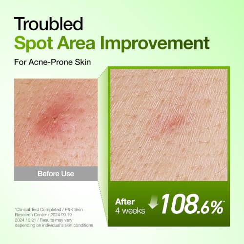 Anua Azelaic Acid 10 Hyaluron Redness Soothing Serum