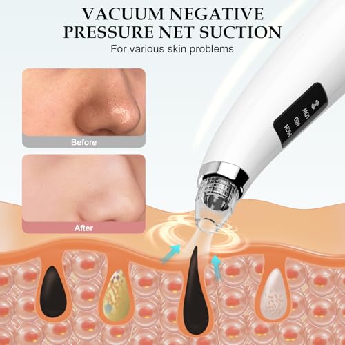Blackhead Remover Pore Vacuum 5 Attachments 3 Suction Levels White