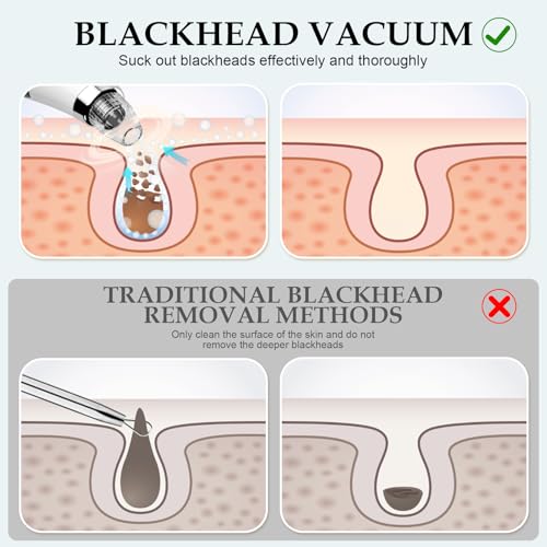 Blackhead Remover Pore Vacuum 5 Attachments 3 Suction Levels White