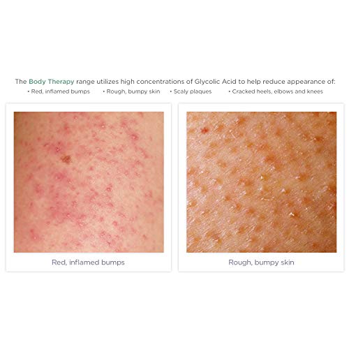 Exfoliating Body Lotion for Dry Skin