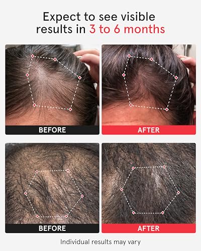 Professional Laser Red Light Therapy Hair Growth System FDA Cleared