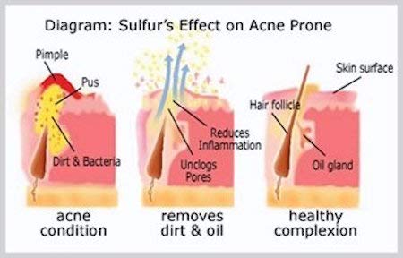 sulfur acne soap 100g