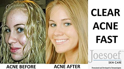 sulfur acne soap 100g