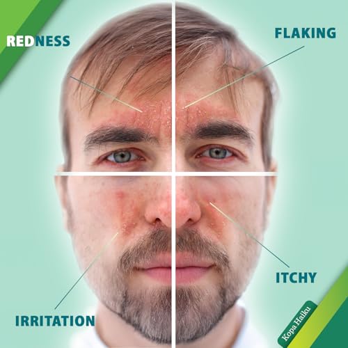 Seborrheic Dermatitis Face Cream: Psoriasis & Fungal-Prone Skin Care