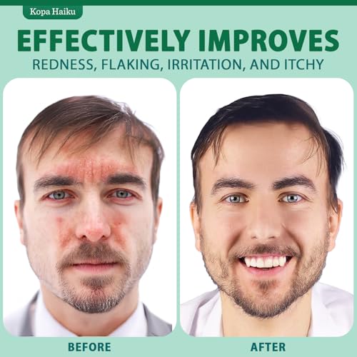 Seborrheic Dermatitis Face Cream: Psoriasis & Fungal-Prone Skin Care