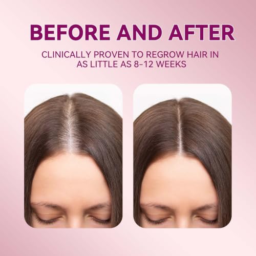 5% Minoxidil Hair Growth Serum for Women
