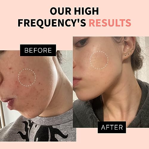OxyGlow 2 Cordless High Frequency Facial Wand Face and Scalp