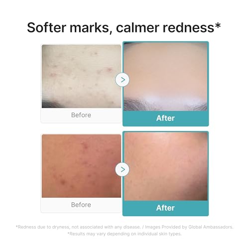 Azelaic Acid Calming Serum