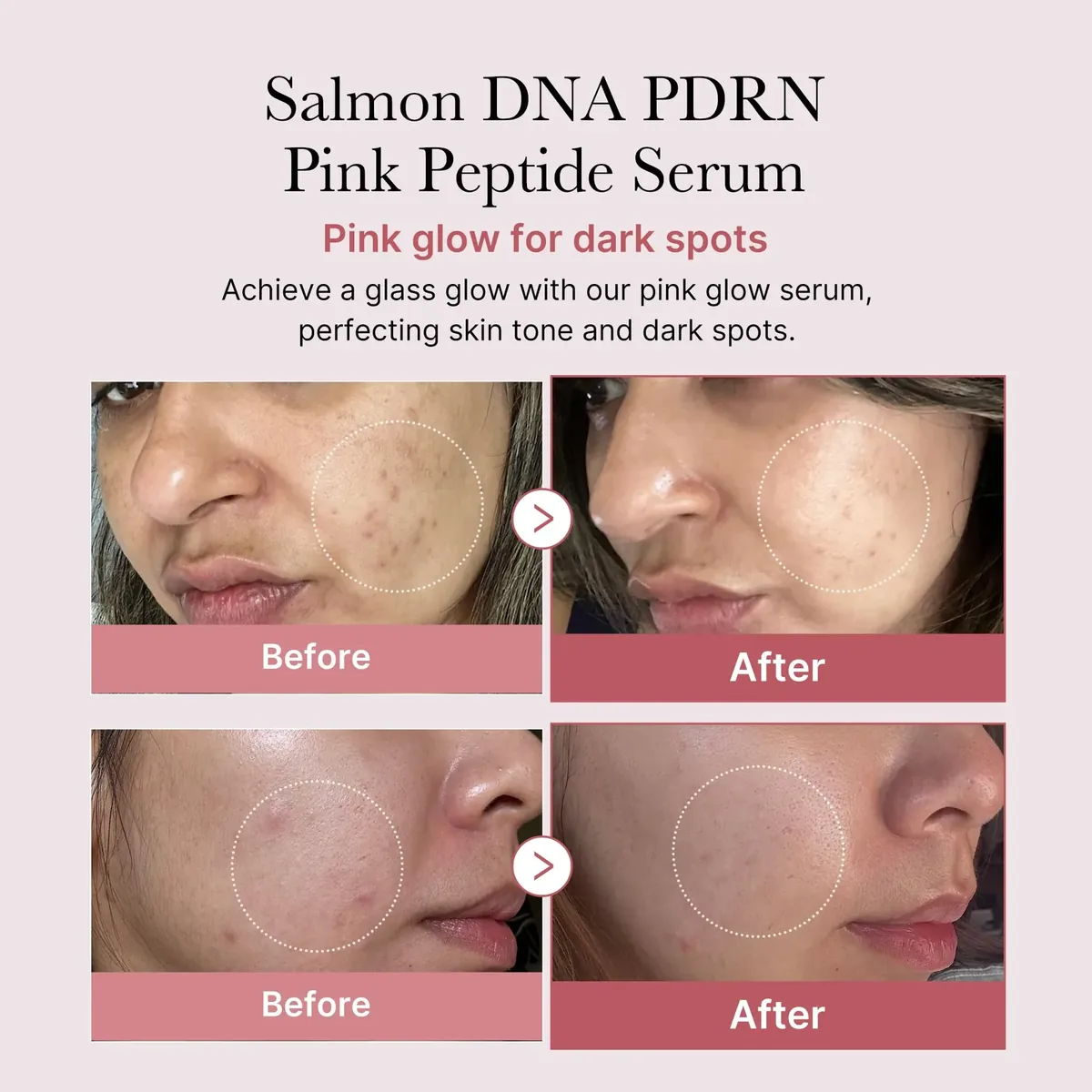 Zero Pore Pads & Salmon Serum