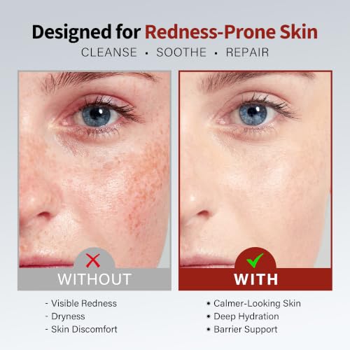 Rosacea Treatment for Face Anti-Redness Cleanser 150 mL / 5.07 fl oz