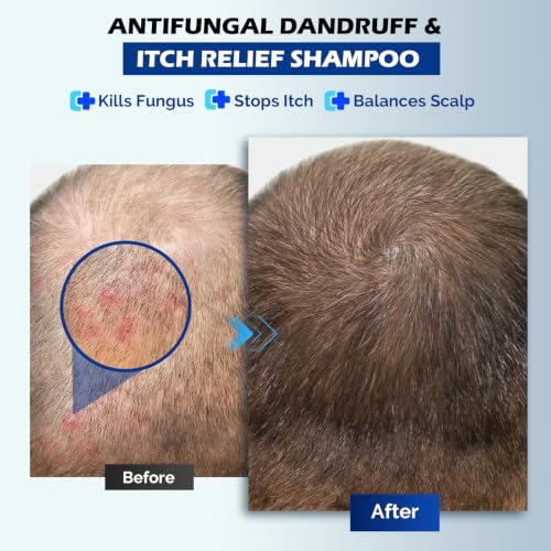 Antifungal Shampoo for Seborrheic Dermatitis, Folliculitis