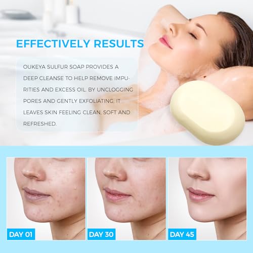 10% sulfur 2% salicylic acid soap 2 pack