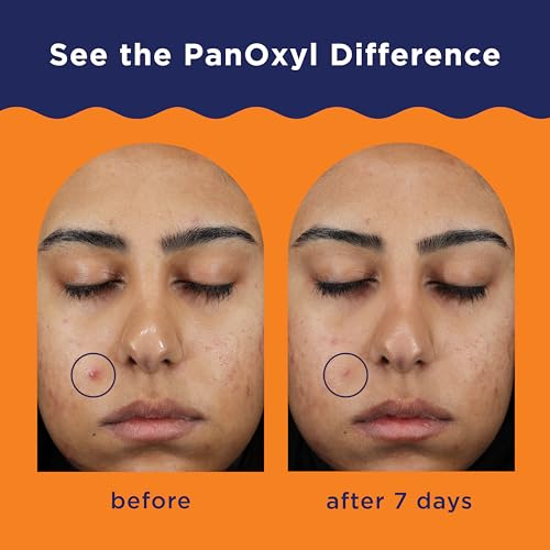 10% Benzoyl Peroxide Spot Treatment