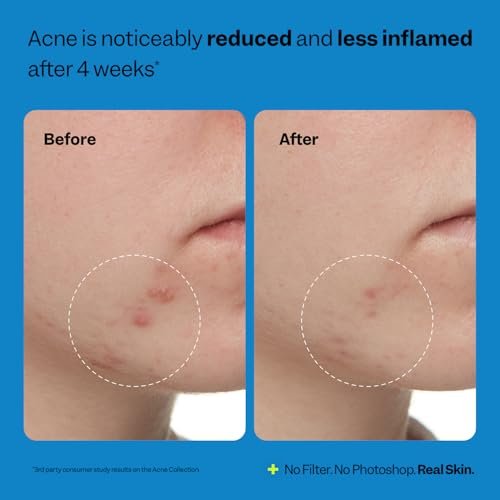 Acne Exfoliating Toner 2% Salicylic Acid