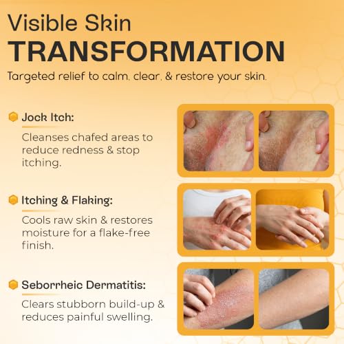 Psoriasis & Antifungal Body Wash with Manuka Honey