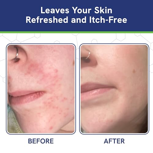 Seborrheic dermatitis Moisturizing Cream & Face Lotion for Women - Soothing Redness for Fa
