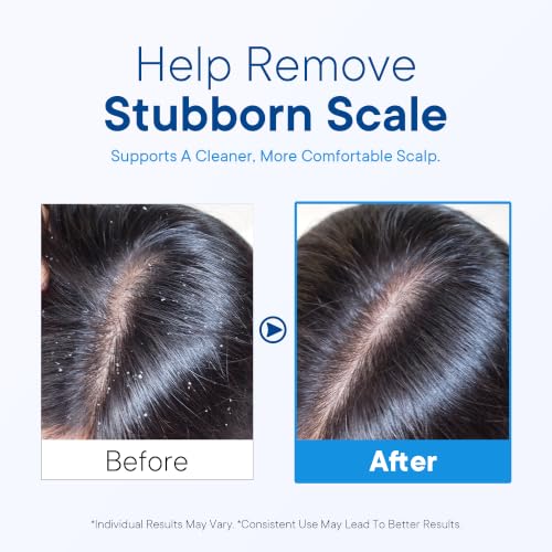 Anti Dandruff shampoo: Antifungal Scalp Treatment for Dandruff