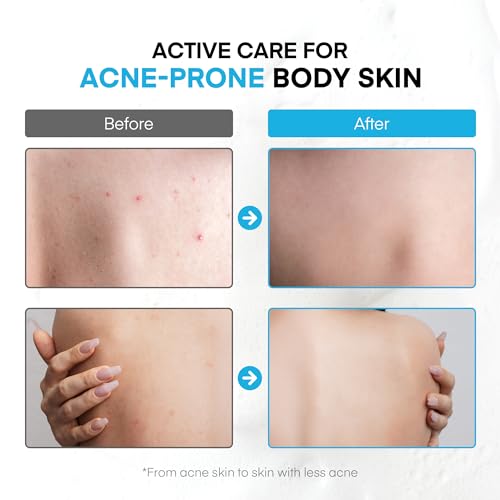 Antibacterial Body Wash for Body Acne & Breakouts, Back Acne, Body Odor & Razor Bumps, Daily Body Wash & Body Soap for Oily & Acne-Prone Skin, Men & Women (Body Wash)