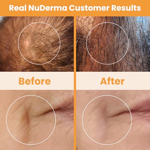 NuDerma Handheld Skin Therapy Wand Machine with Neon