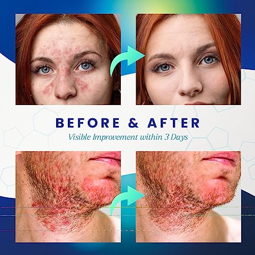 Seborrheic Dermatitis Face Cream: Antifungal Psoriasis Cream - Traditional Herbal Infused 
