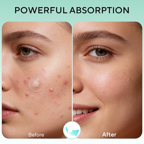 580 Count Large Hydrocolloid Acne Patches
