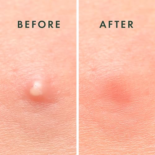 Miracle Invisible Spot Cover 96 Ct