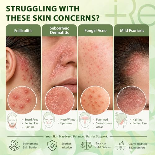 Seborrheic Dermatitis Face Cream: Steroid-Free Formula for Mild Psoriasis – Soothes Rednes