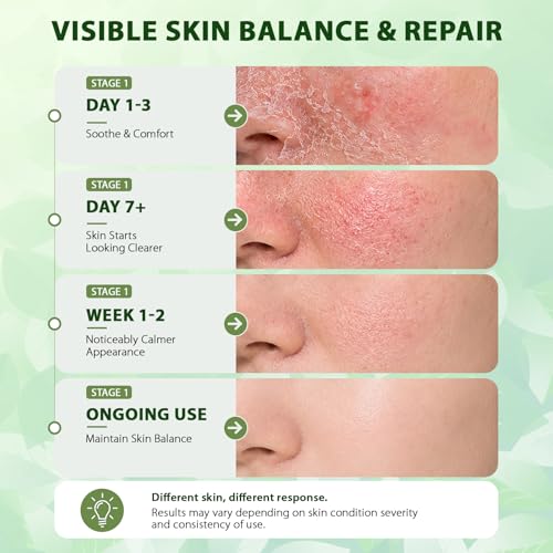 Seborrheic Dermatitis Face Cream: Steroid-Free Formula for Mild Psoriasis – Soothes Rednes