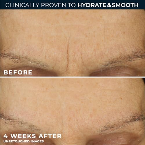 Hyaluronic Acid